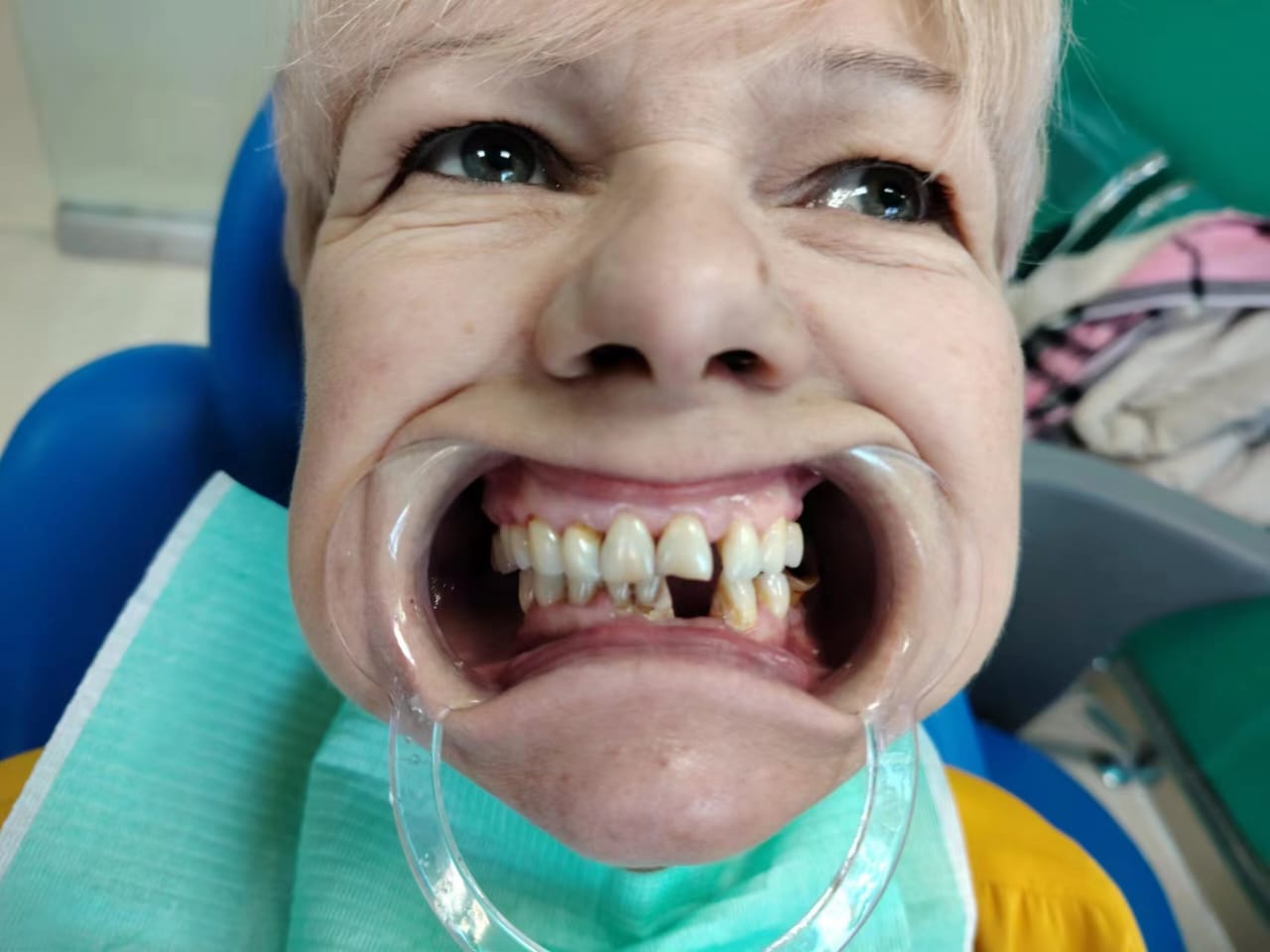 Отзыв о протезировании зубов в Китае